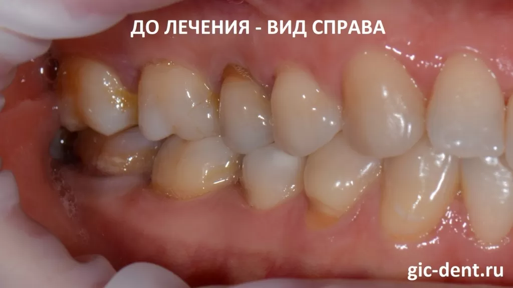 Например, верхний жевательный зуб 1.5 тотально изменен в цвете, весь буквально «слеплен из пломб». Снизу также присутствуют жевательные зубы, которые изменены в цвете.